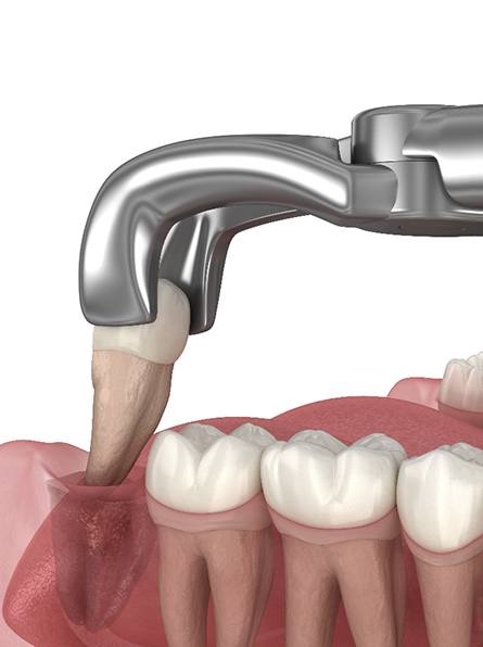 Illustration of a tooth being extracted