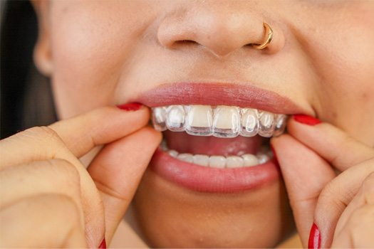 Woman putting in clear aligners