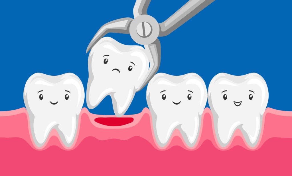Illustration of a tooth being extracted